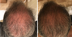 Non-Surgical Hair Regrowth